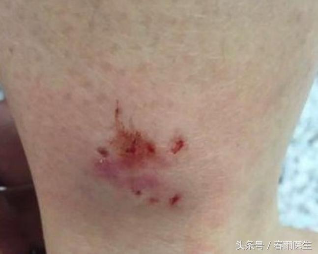 被狗咬了打狂犬疫苗打一针可以吗,被狗咬了打狂犬疫苗