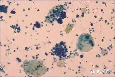 孕妇尿结晶数值多少是结石,尿结晶数量高看什么科