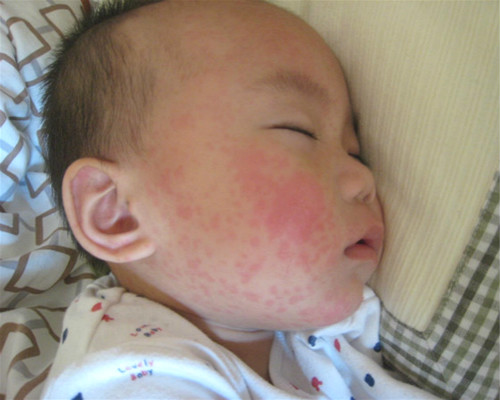 幼儿急疹出现的高热惊厥,幼儿高烧39度惊厥