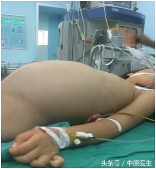 5岁女孩肚子突然变大,4岁女孩肚子肿瘤