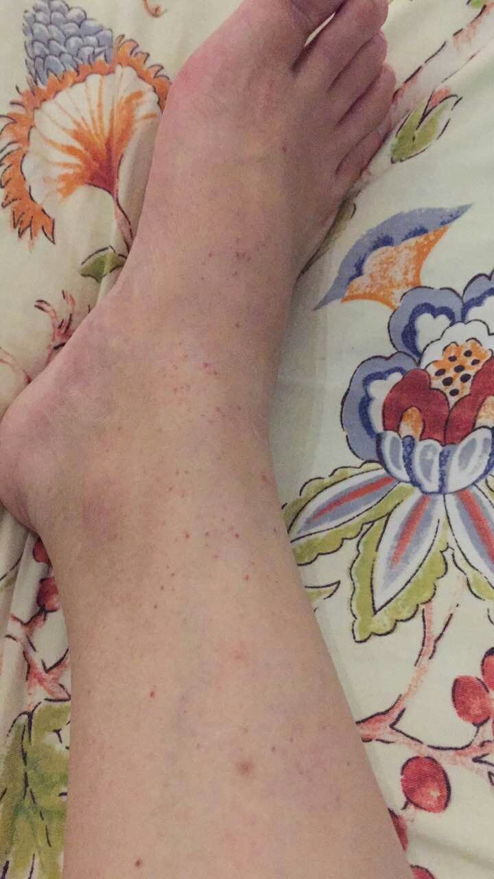 乏力、双下肢不痛痒的“出血点”，竟是“累出来”的“血液病”？