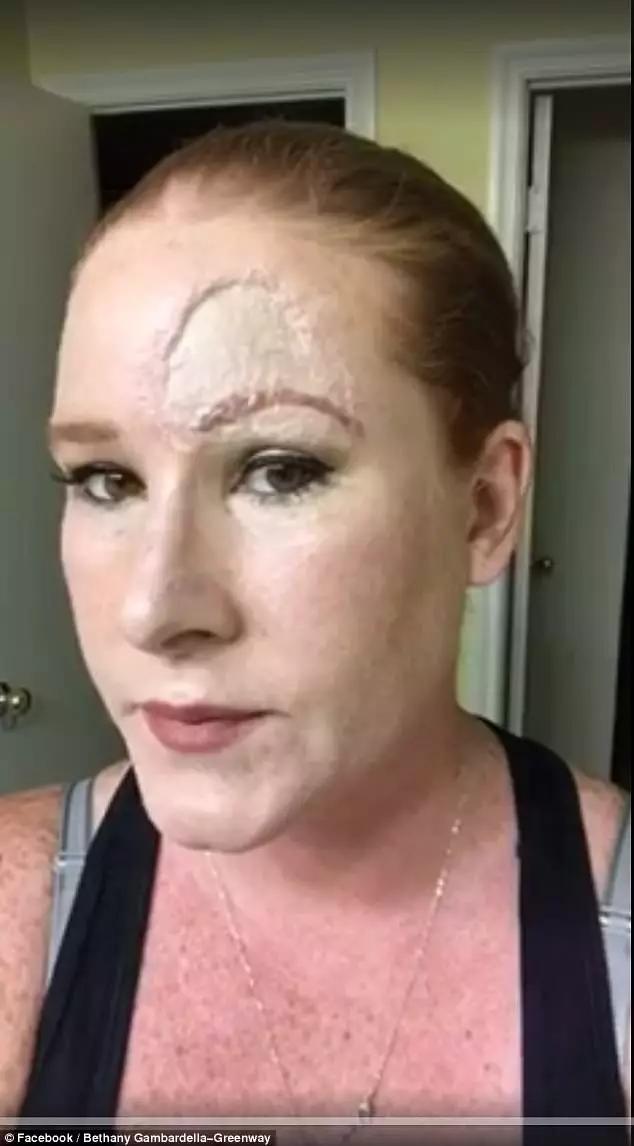 澳女脸上长了个黑包，竟是皮肤癌！只能用腿部皮肤移植到额头！