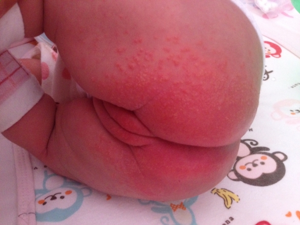 小儿湿疹的推拿方法,宝宝脚上长湿疹小儿推拿按哪