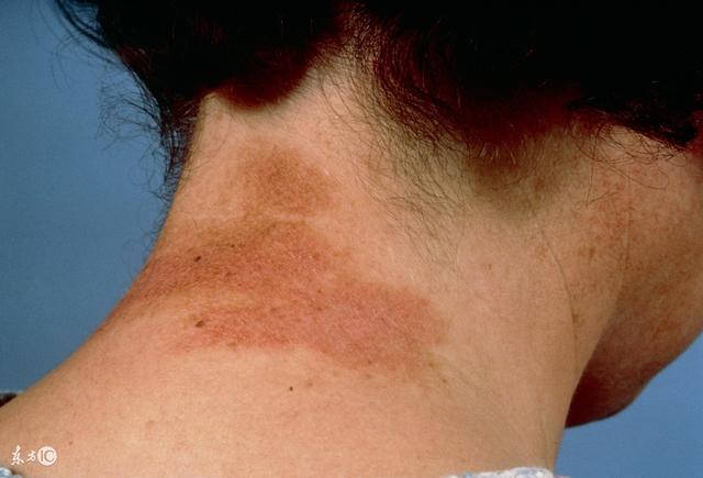 过敏性皮炎很难缠中医来帮你排忧解难