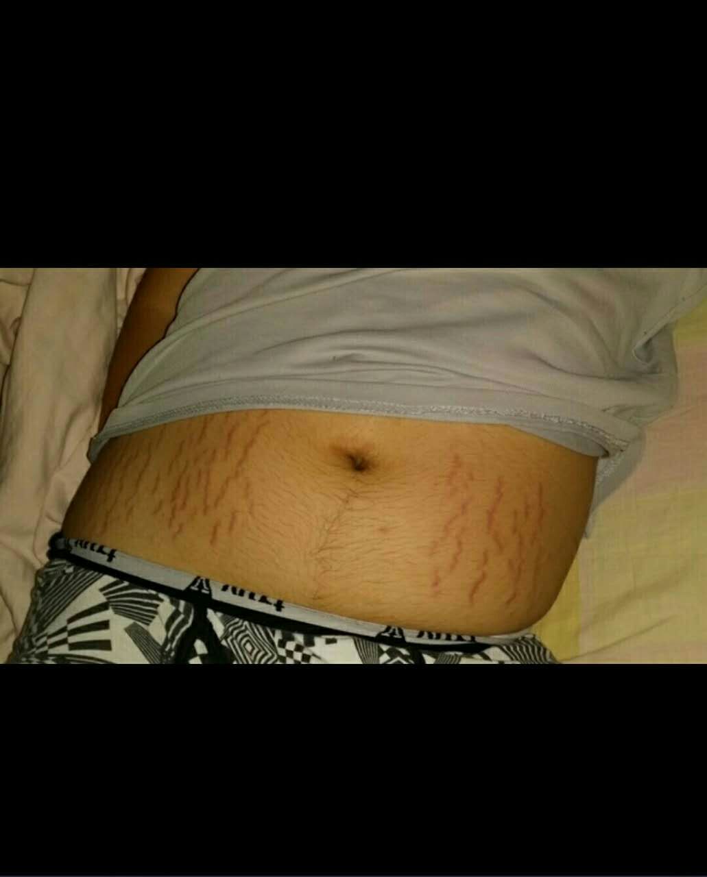 肥胖纹怎么消除产后,肥胖纹怎么消除涂什么药