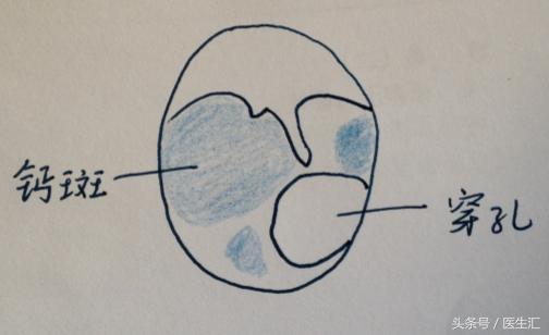 听力低频下降怎么恢复,低频听力下降耳鸣怎么治疗