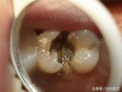 蛀牙为什么要治很多次,牙齿蛀牙高发如何有效预防和治疗