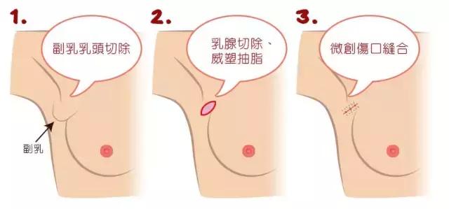 告别副乳甩掉拜拜肉,不胖但是有点副乳怎么减