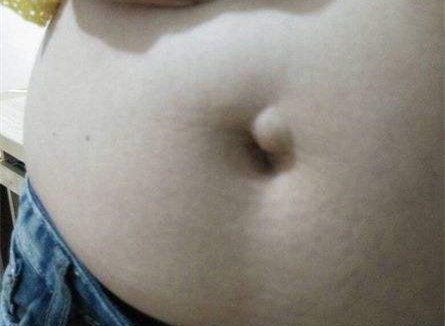 女子腹部有小包块，2次手术切除还是复发，专家揭示其中原因