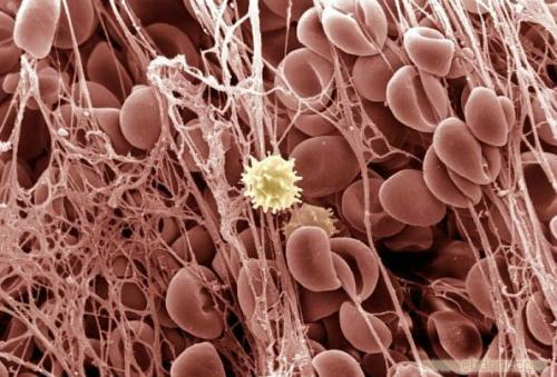 皮肤出紫癜图片,白血病皮肤出血点与紫癜的区别