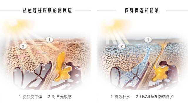 痘疮最好的治疗方法,疮疡和痘痘有什么区别