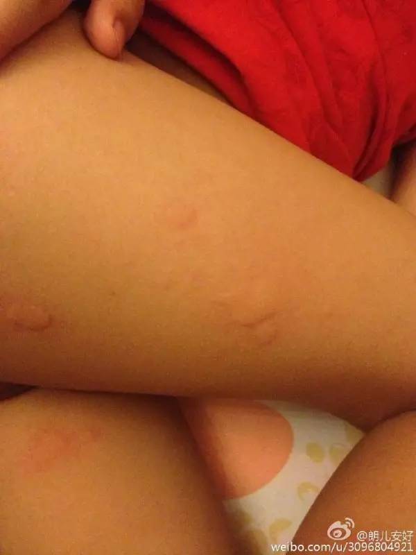 崔玉涛荨麻疹,崔玉涛幼儿慢性荨麻疹