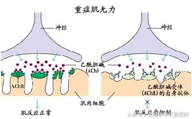甲亢肌无力属于甲亢危象吗,甲亢肌无力并发症怎么治疗