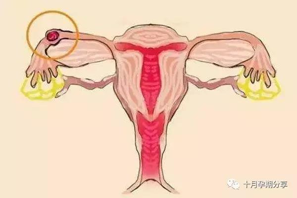 宫外孕一侧输卵切除后2年不孕,生过孩子宫外孕后不孕了怎么回事