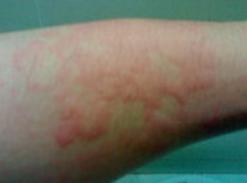 情绪不好出现皮肤病,情绪不稳定得皮肤病