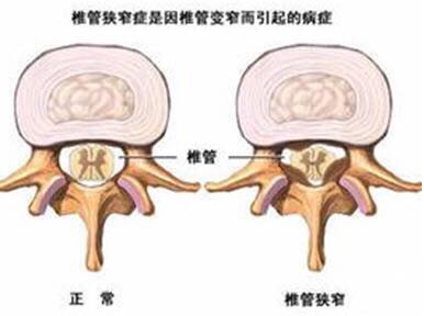 患颈椎管狭窄的病例多吗,颈椎管狭窄最佳睡姿