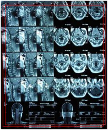 椎管内海绵状血管瘤都要手术吗？