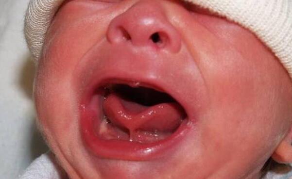 宝宝舌头w型是舌系带短吗,宝宝舌头w型一定要做手术吗