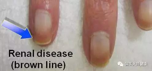 指甲上的月牙预示着什么,指甲上的月牙真的和健康有关系吗