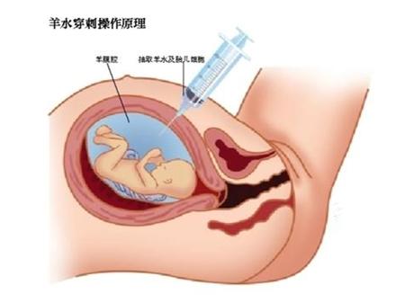 羊水不足的宝宝是不是不怎么动,羊水不足的宝宝