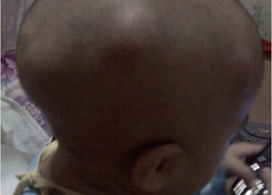 宝宝额头上的包越来越大,宝宝额头上的包变硬了