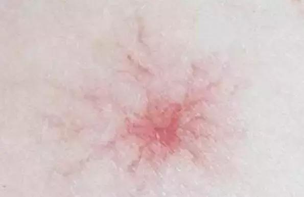 60岁身上现小红痣是什么原因,身上出现小红痣是什么原因造成的