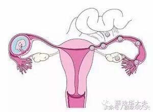 实习医生误诊宫外孕后续,宫角孕和宫外孕会误诊吗