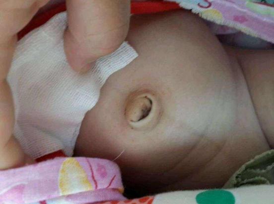 宝宝肚脐眼鼓用硬币怎么弄,看宝宝有没有肠胀气