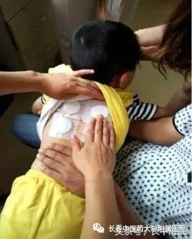 小儿疱疹性咽峡炎用什么中药贴敷,儿科孙丽萍