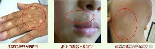 白癜风毛发变白治疗手段,白癜风是主流的治疗手段啥意思