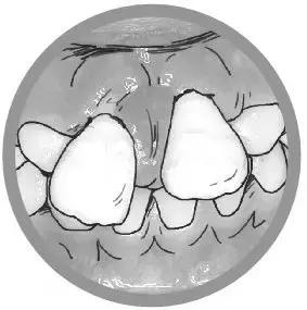 矫正牙齿自己戴皮筋儿童,牙齿矫正橡皮筋牵引门牙