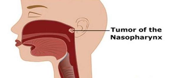 鼻咽癌患者最新明细,早期鼻咽癌的患者治愈率和生存期