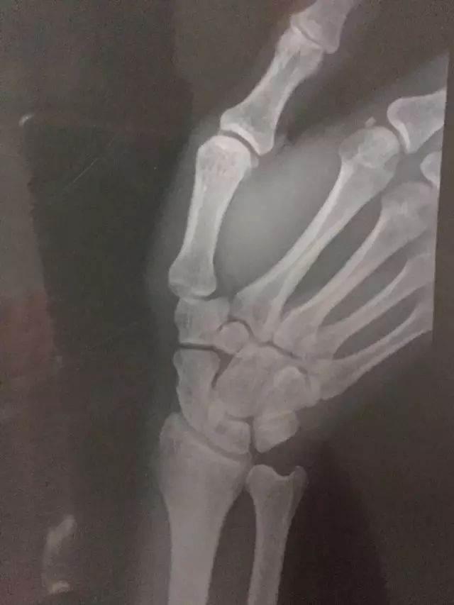 网球肘的最佳打法,三招搞定网球肘