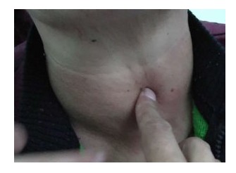 多发性甲状腺结节需要手术吗,多发甲状腺结节怎样做手术