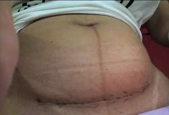 剖腹产后伤口24天化脓,剖腹产伤口有个小洞流脓多久好