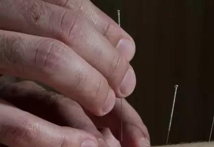 膝关节炎针灸五针疗法用何穴,膝关节炎的针灸治疗的穴位