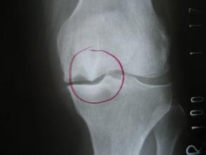 骨刺和骨质增生的区别图,骨刺与骨质增生有哪些区别