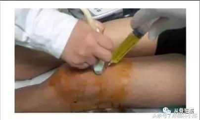 滑膜炎打消炎药有用吗,滑膜炎吃消炎药有用吗