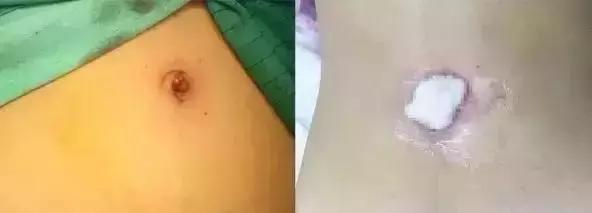 无瘢痕手术:单孔腹腔镜,让爱美女性不再为“疤”苦恼