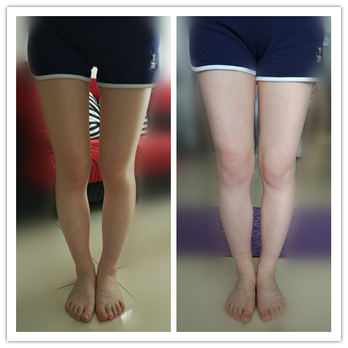 怎样改善x腿型和o腿型,通过调整脚型来改善x型腿