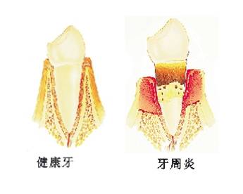 孕妇牙疼的时候可以拔牙吗,孕期牙疼能上医院拔牙吗