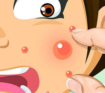 如何彻底告别痘痘成人痘,有一种痘很大个是红色的