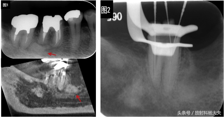牙痛绝非小事有可能是大病前兆,牙痛可能是什么病的前兆