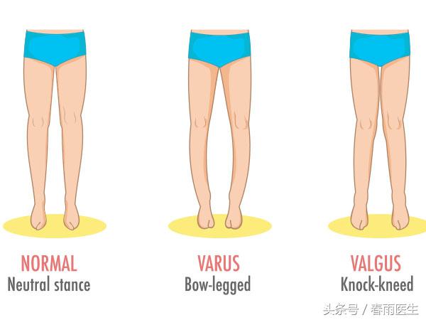儿童睡觉绑腿能改善腿型吗,孩子腿有点拐怎么回事