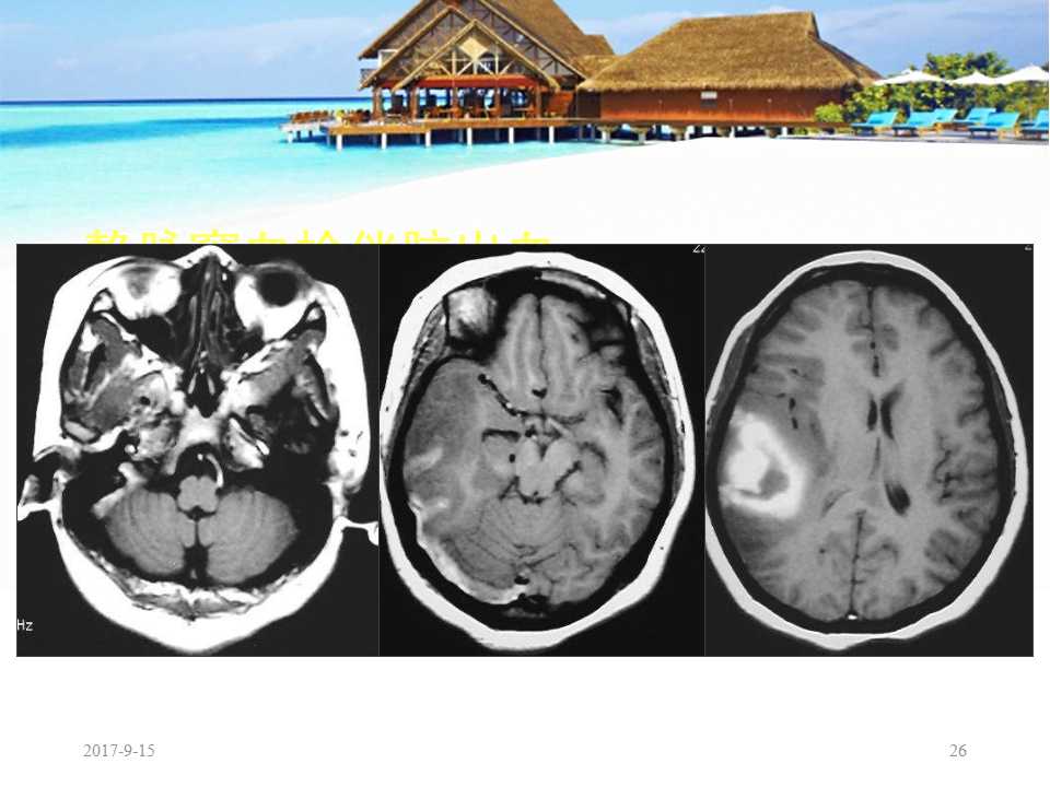 颅内静脉窦血栓形成怎么治疗,颅内静脉窦血栓怎么治疗