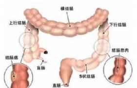 肠癌肝转移严重腹胀怎么解决,吗丁啉对肠癌患者腹胀有用吗