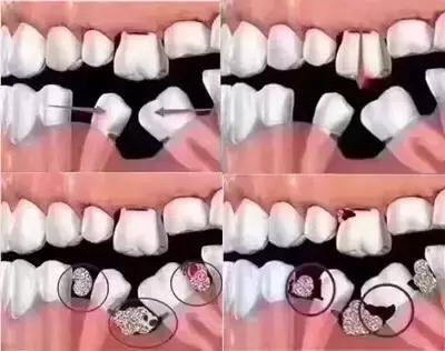 牙龈肿痛牙齿松动是怎么回事,牙齿松动咬硬东西痛怎么回事