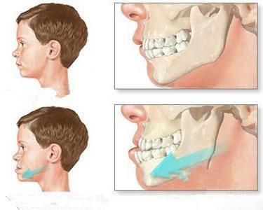 宝宝多久戒奶瓶不会造成龅牙,婴儿一直喝奶瓶一定会变成龅牙吗