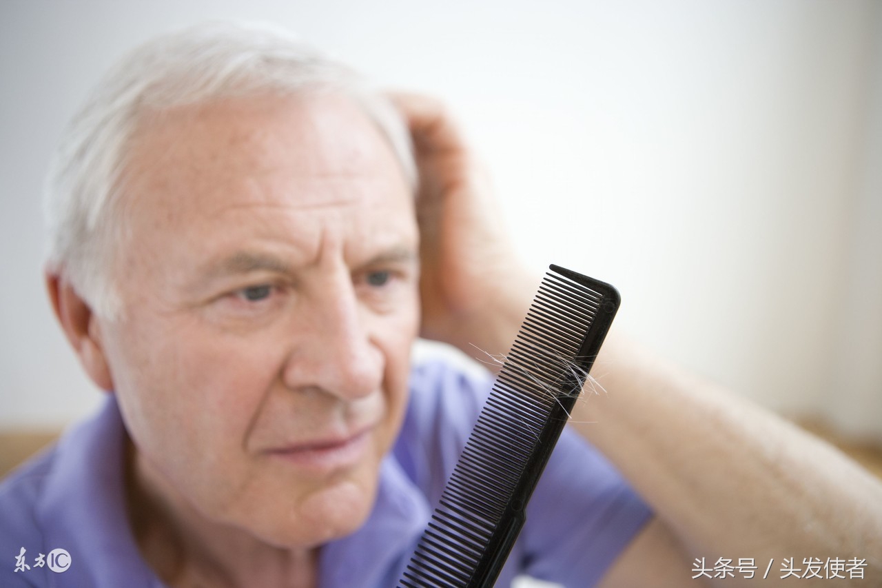 脱发发际线上扬怎么办,严重脱发秃顶发际线后移如何改善