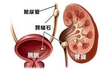 男性肾结石患者结石如何排出体外,肾结石1.6厘米结石能体外碎石吗